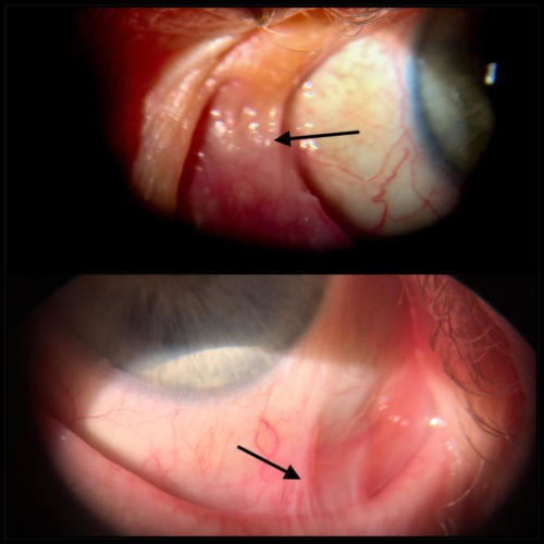 Ankyloblepharon and symblepharon - Ocular cicatricial pemphigoid